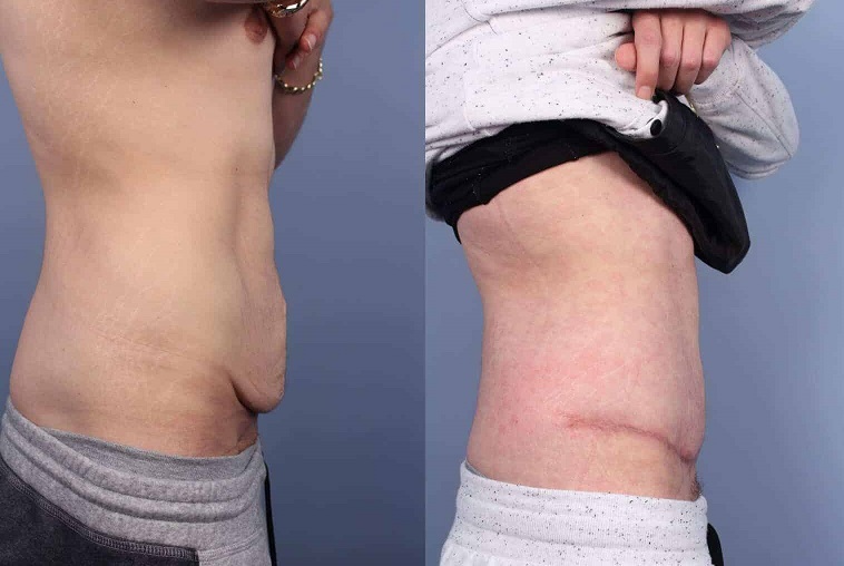بررسی فرم بدن بعد از جراحی با گن مردانه