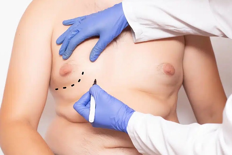 روشهای درمان ژنیکوماستی شامل جراحی، دارو، لیپوساکشن و کرایولیپولیز