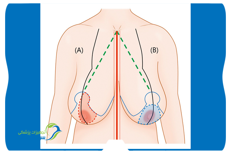 Mammoplasty